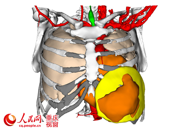 数字化人体:从传统解剖到3D打印精准医疗