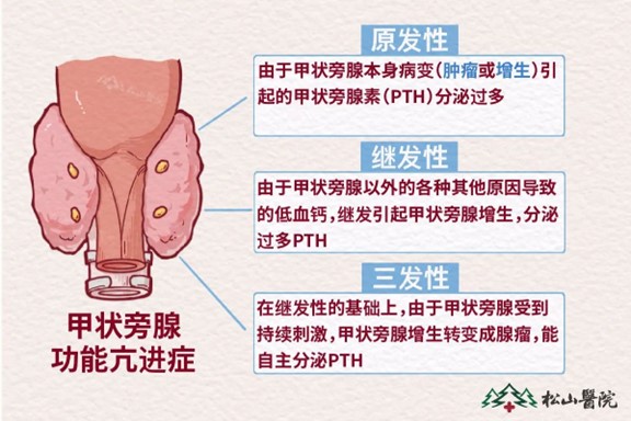 甲状旁腺类型。重庆松山医院供图
