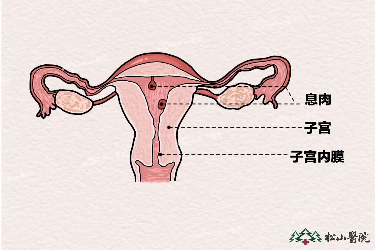 子宮內膜息肉。重慶鬆山醫院供圖