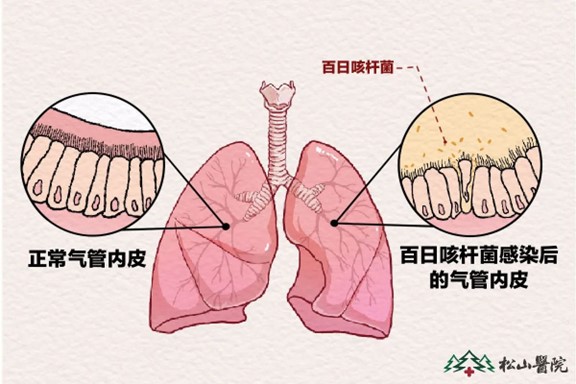 百日咳杆菌感染。重庆松山医院供图