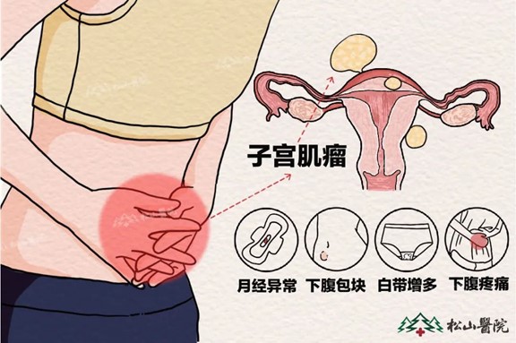 子宫肌瘤症状。重庆松山医院供图