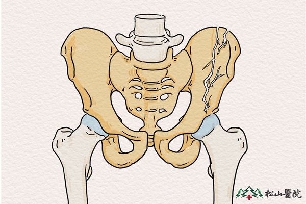 骨盆骨折示意圖。重慶鬆山醫院供圖