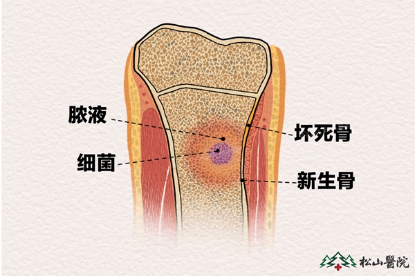 骨髓炎示意圖。重慶鬆山醫院供圖