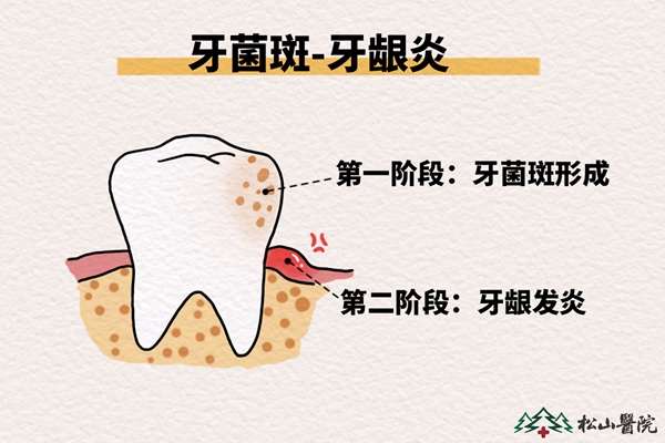 牙齦炎的形成過程。重慶鬆山醫院供圖