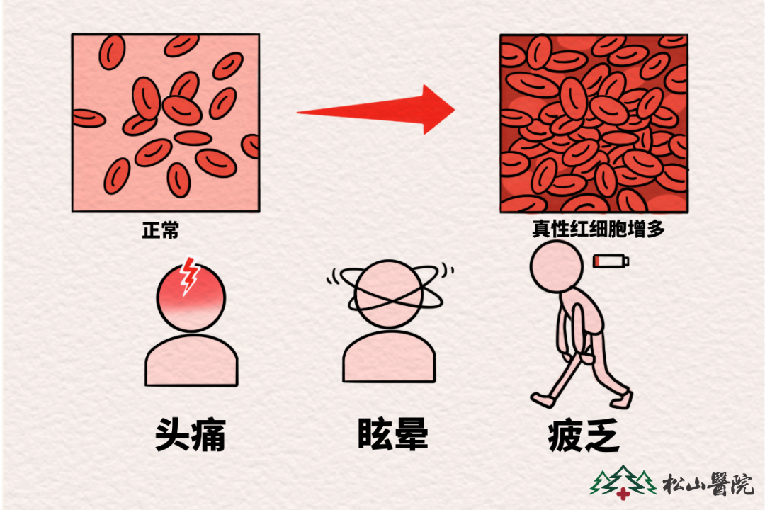 真性红细胞增多症。重庆松山医院供图