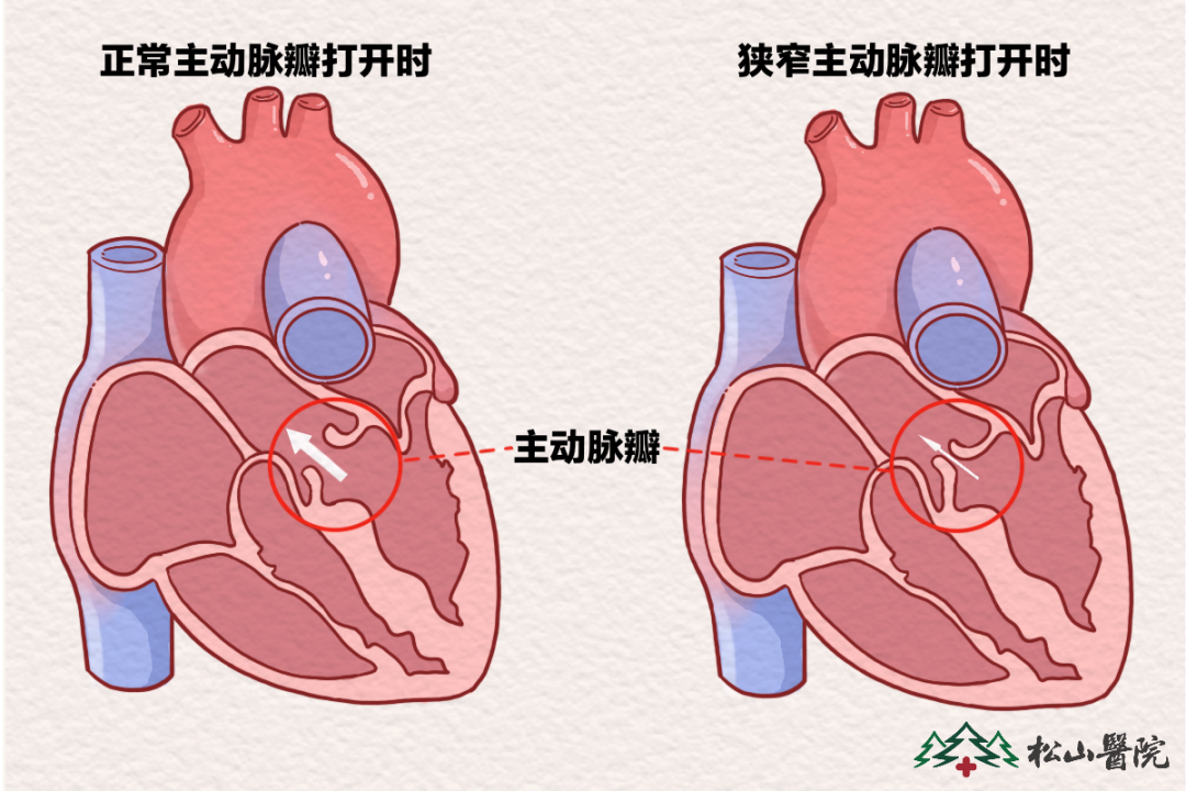 主动脉瓣。重庆松山医院供图