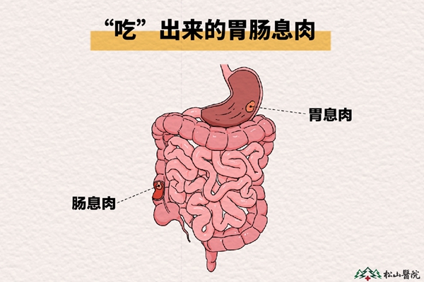 胃腸息肉。重慶鬆山醫院供圖