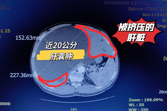 CT影像。重慶鬆山醫院供圖