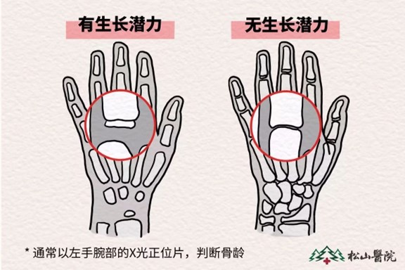 骨齡監測。重慶鬆山醫院供圖