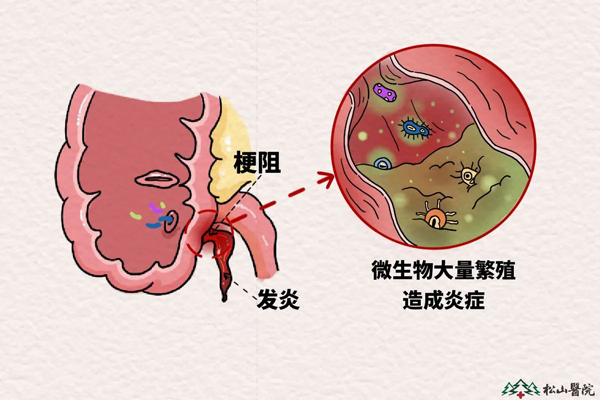 闌尾發炎示意圖。重慶鬆山醫院供圖