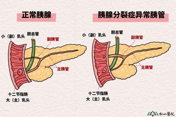 胰腺分裂症示意圖。重慶鬆山醫院供圖