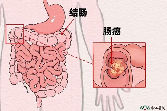 示意圖。重慶鬆山醫院供圖