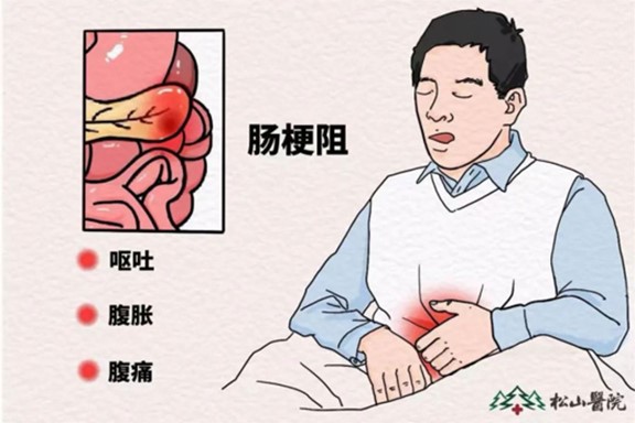 肠梗阻。重庆松山医院供图