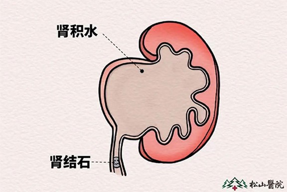 肾结石的危害。重庆松山医院供图