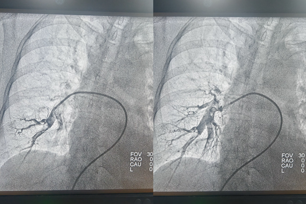手术前后肺动脉造影对比。重庆两江新区人民医院供图