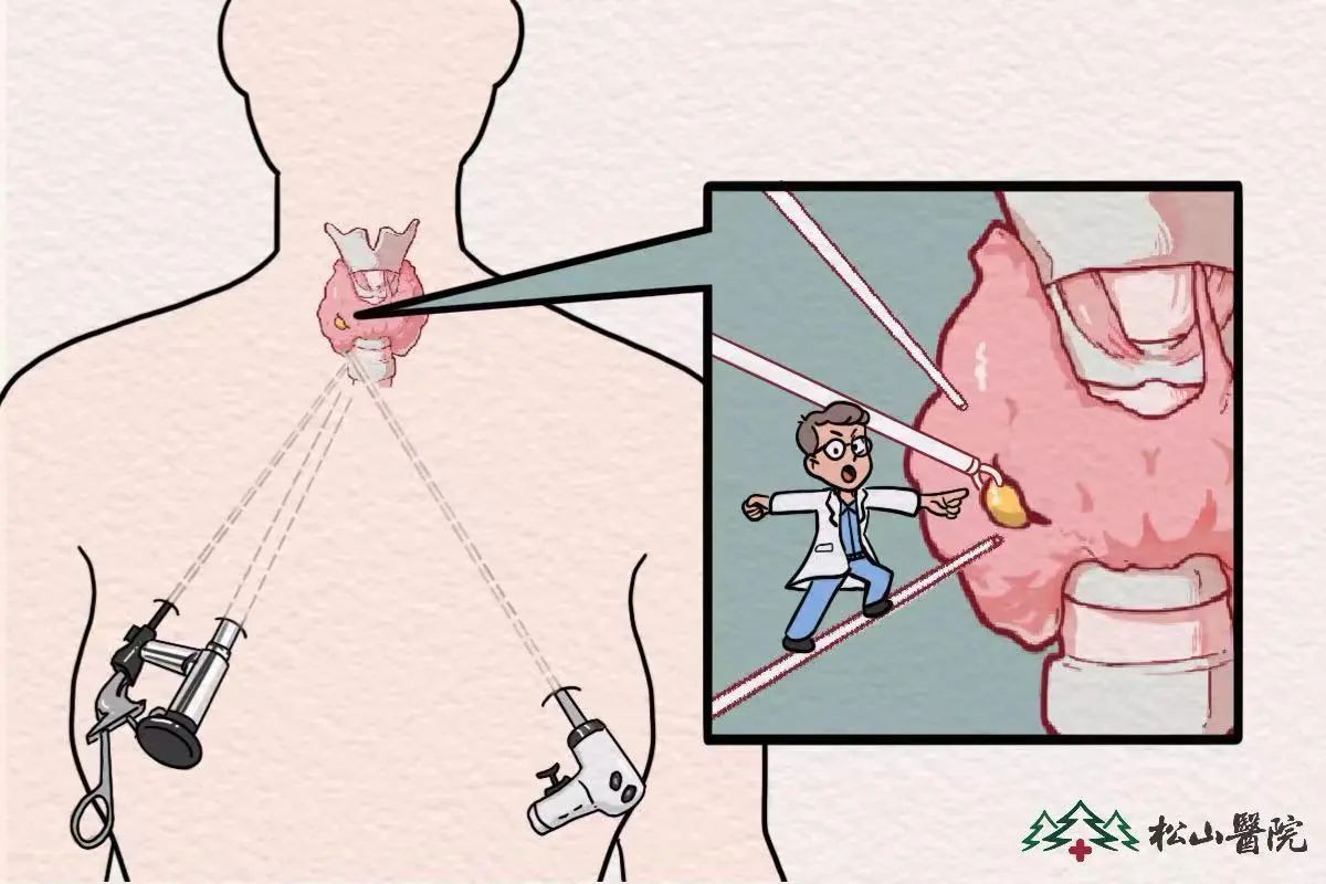 腔镜下甲状腺手术。重庆松山医院供图