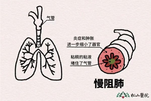 示意图。重庆松山医院供图