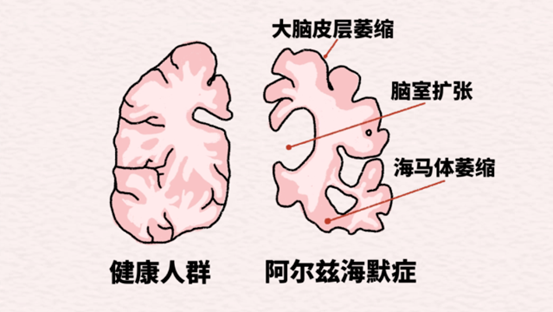 示意图。重庆松山医院供图