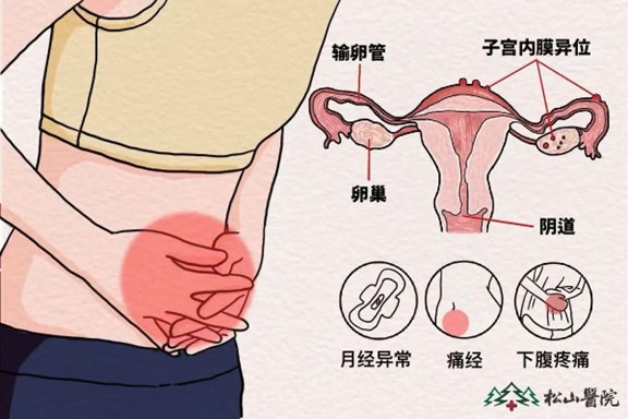 子宫内膜异位症。重庆松山医院供图