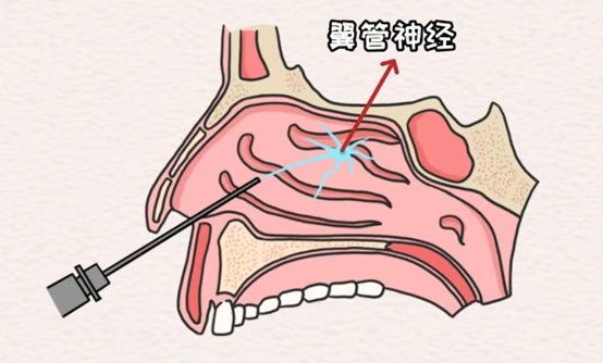 示意图。重庆松山医院供图