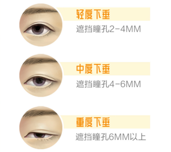 上睑下垂示意图。重庆南坪爱尔眼科医院供图