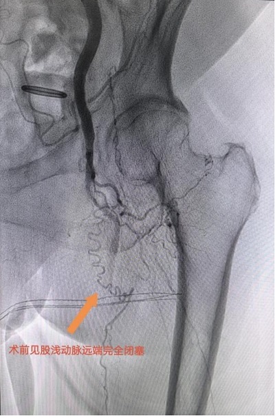 患者左腿動脈血管閉塞嚴重。重醫附屬大學城醫院供圖