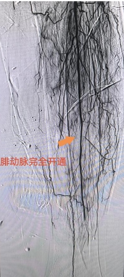 術后，患者左腿部腓動脈血管完全開通。重醫附屬大學城醫院供圖