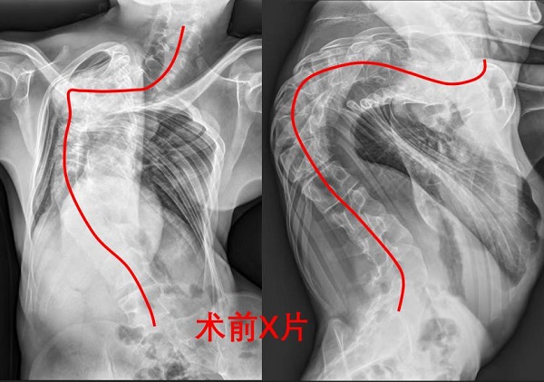 術前X片顯示，患者脊柱形態（紅線處）嚴重側彎。重醫附二院供圖