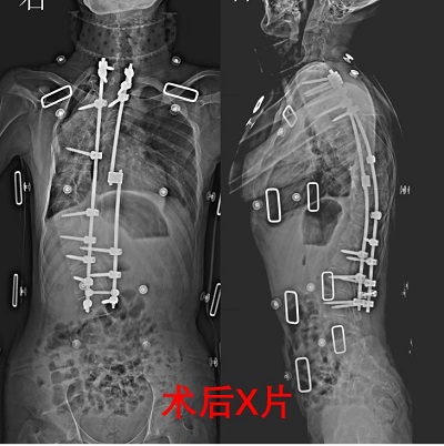 術后x片顯示，患者脊柱情況得到明顯改善。重醫附二院供圖